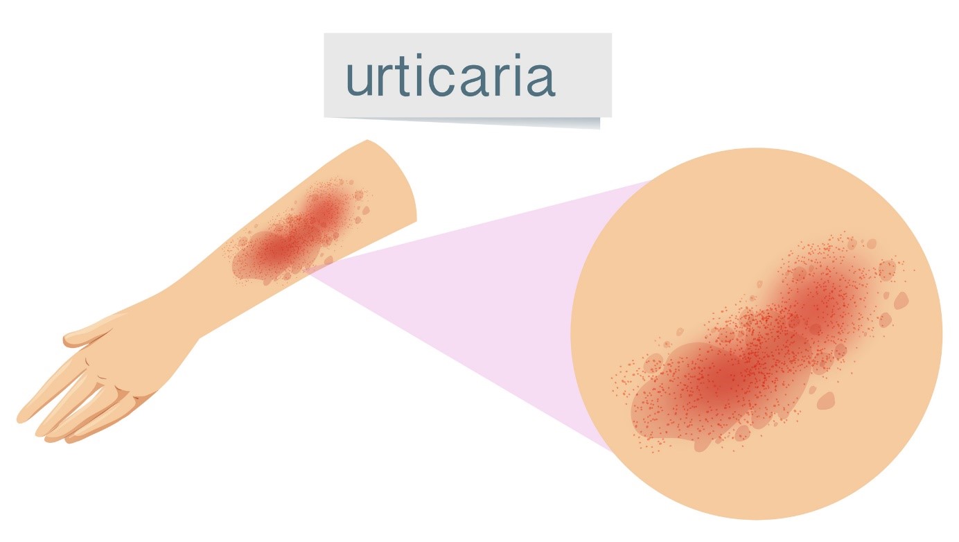 Urticária, fonte: Getty Images Urticária, urticária, urticária, urticária, urticária, urticária