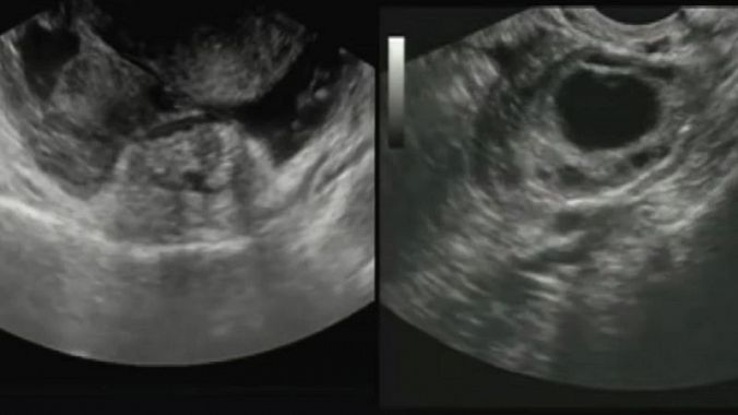 Sonografia para confirmar o diagnóstico. Fonte: Getty Images USG - ecografia do abdómen - imagem durante o exame, imagem do útero e gravidez ectópica