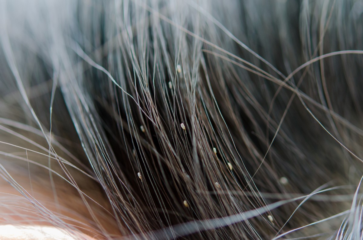 Para além dos próprios piolhos, também se podem encontrar ovos e ninfas no cabelo: Getty Images Piolhos, ninfas e ovos no cabelo