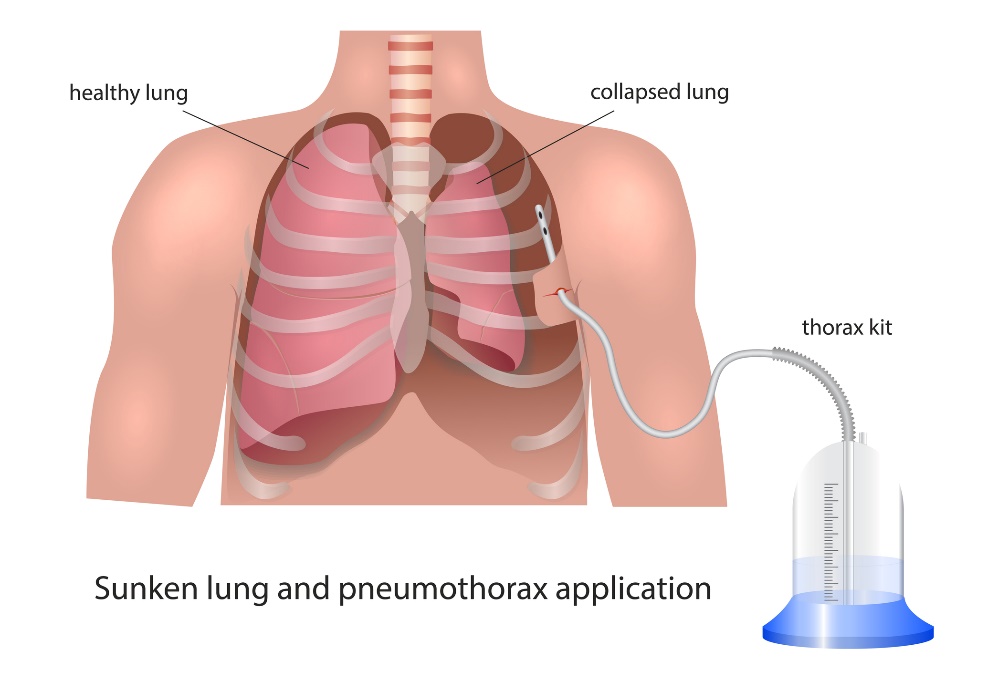 Visualização da drenagem pleural no pneumotórax: pulmão saudável, pulmão colapsado e dispositivo de drenagem: Getty Images Visualização da drenagem pleural no pneumotórax: pulmão saudável, pulmão colapsado e dispositivo de drenagem