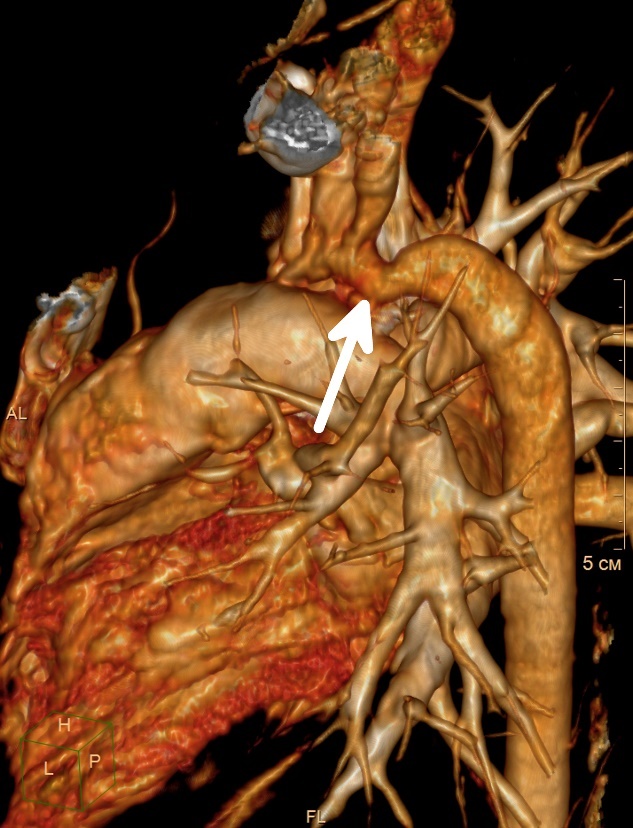 Visualização da coartação (estreitamento) da aorta na parte descendente do vaso cardíaco: Getty Images Visualização da coartação (estreitamento) da aorta na parte descendente do vaso cardíaco.