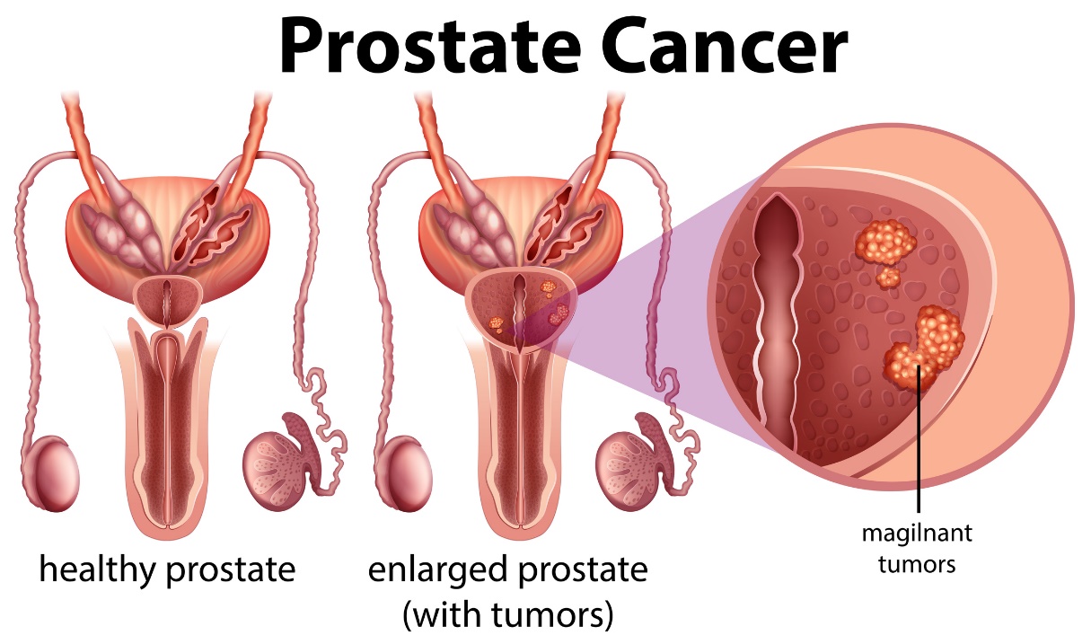Cancro da próstata. próstata saudável e próstata aumentada com tumor. fonte da foto: Getty Images Cancro da próstata: próstata saudável e próstata aumentada com tumor