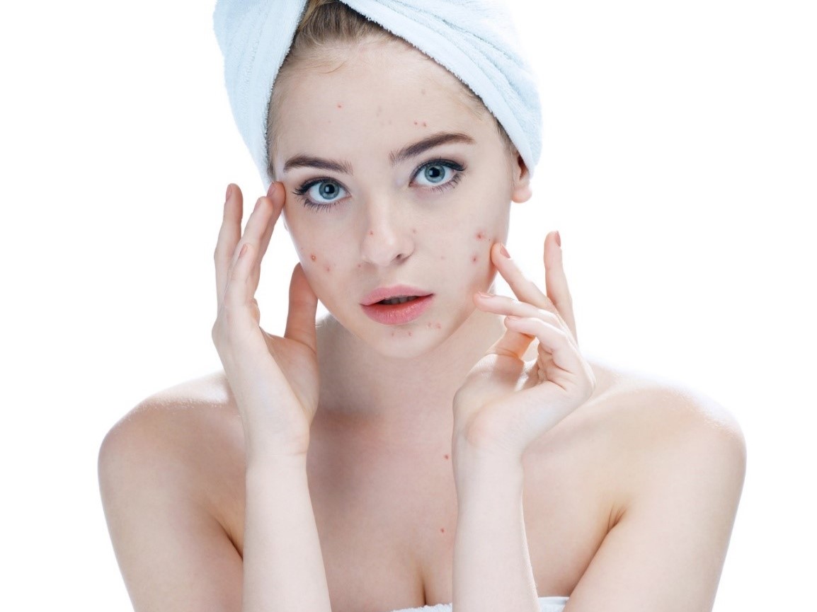 Um exame profissional é importante para determinar o tratamento adequado: Getty Images Acne no rosto de uma mulher, cabelo numa toalha