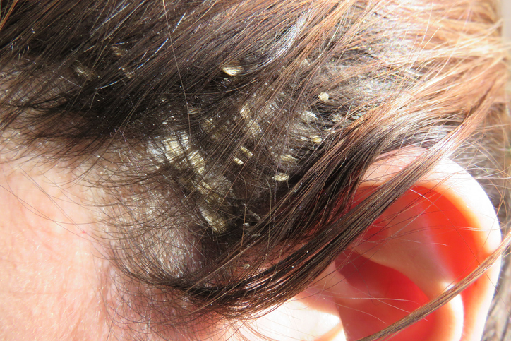 Caspa grande no cabelo quando a caspa é produzida em excesso: Getty Images Uma mulher tem um problema de caspa no seu cabelo