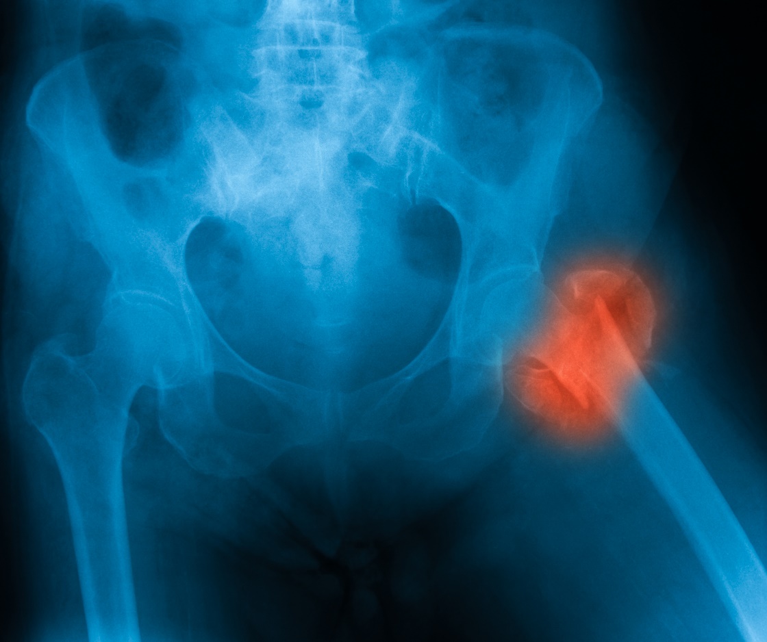 A fractura do colo do fémur é a fractura osteoporótica mais crítica: Getty Images Fractura do colo do fémur
