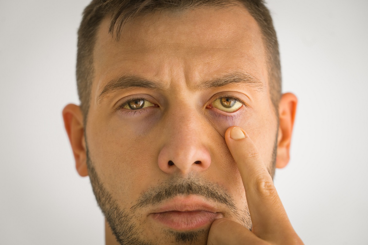 Um sintoma típico da doença hepática é a descoloração amarela da pele e das escleróticas dos olhos: Getty Images Descoloração amarela da pele e das escleróticas