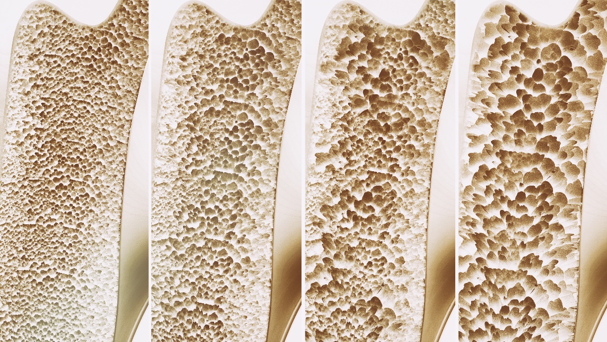 Renderização das alterações da densidade óssea numa secção transversal do osso. A partir da esquerda: osso saudável; osso afectado por osteopenia; osso afectado por osteoporose; osso afectado por osteoporose manifesta: Getty Images Alteração da densidade óssea na secção transversal