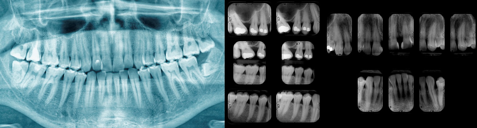 As radiografias dentárias revelam o estado dos dentes, as cáries e as obturações existentes: Getty Images Radiografia dentária para mostrar o estado dos dentes, cáries e obturações