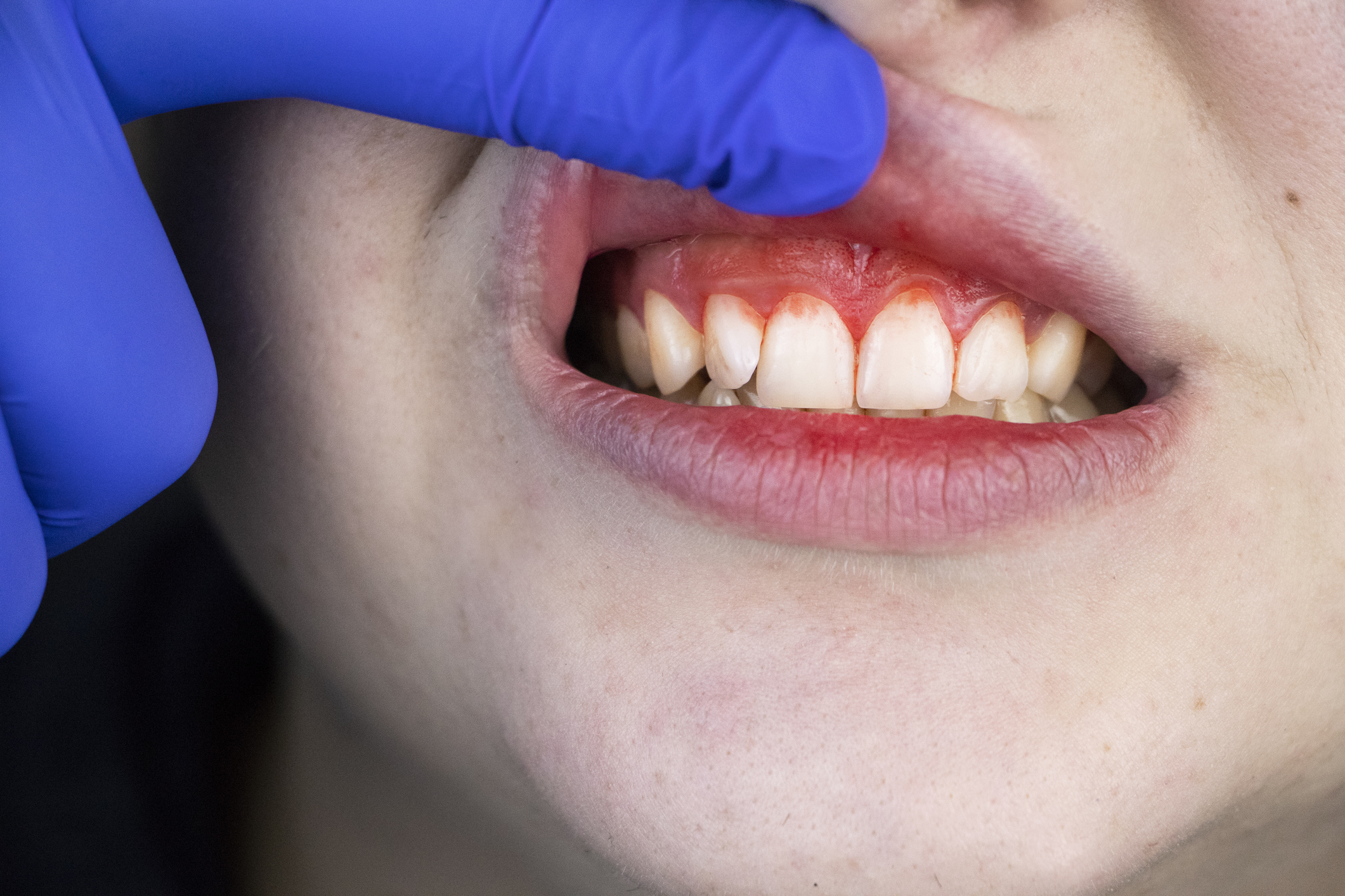 A carência grave de vitamina C leva ao escorbuto, que se manifesta por inchaço e sangramento das gengivas e até perda de dentes: Getty Images Dentes - escorbuto
