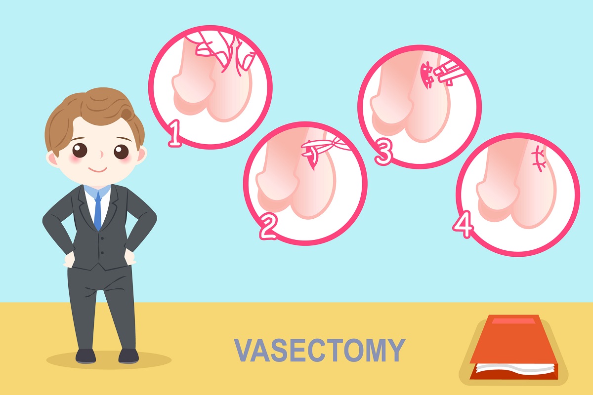 Ilustração da cirurgia de vasectomia Fonte: Getty Images Vasectomia