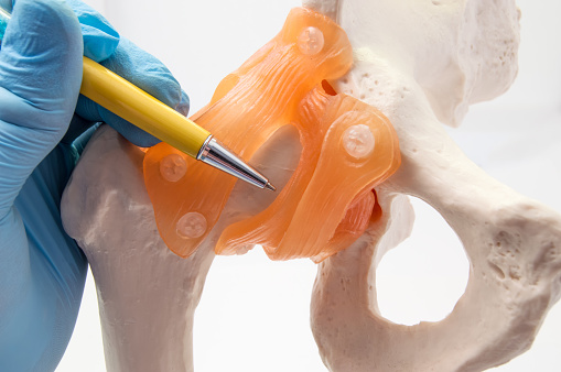 A osteoartrite afecta preferencialmente as grandes articulações, como a anca (na foto) ou o joelho: Getty Images Um médico aponta uma caneta para um modelo de uma anca