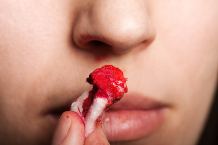Tampão ensopado em sangue. Fonte da fotografia: Getty Images uma mulher com um tampão ensanguentado no nariz