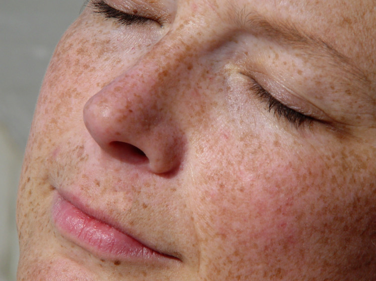Hiperpigmentação. Fonte: Getty Images um rosto feminino satisfeito com manchas de pigmentação e olhos fechados