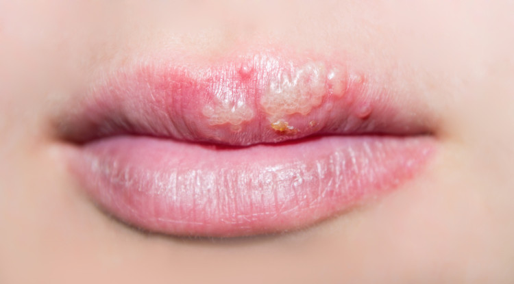 Semeadura herpética simples no lábio superior. Fonte: Getty Images herpes no lábio superior