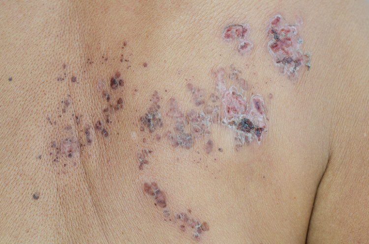 Cicatrizes de herpes zoster, com crostas em alguns sítios. Fonte: Thinkstock Photos crostas e cicatrizes após sementeira herpética