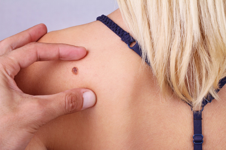 Avaliar o estado de uma verruga ou melanoma Fonte: Getty Images a mão de um médico aponta para um sinal nas costas de uma mulher