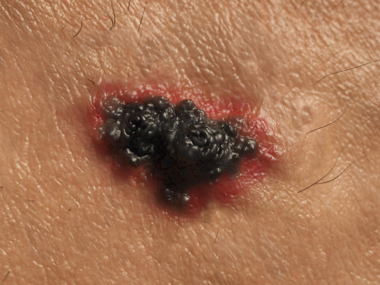 Melanoma maligno, fonte: Getty Images cancro da pele, melanoma negro maligno com bordos vermelhos
