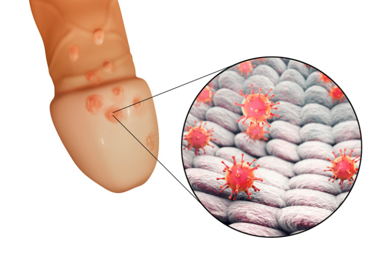 Vírus do herpes no órgão genital masculino Fonte: Getty Images herpes genital no pénis e vírus do herpes a nível microscópico