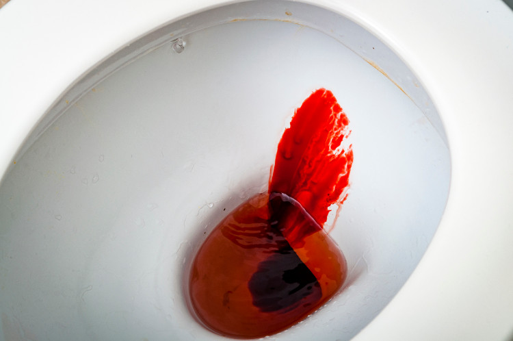 Hemorragia maciça devido a hemorróidas: Getty Images sangue fresco na sanita branca