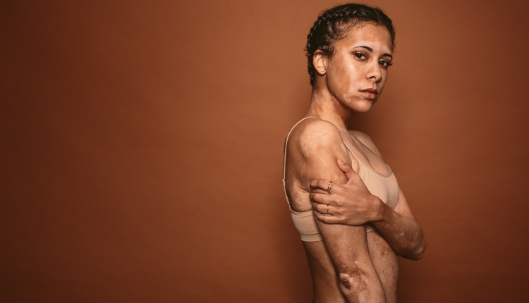 Hipopigmentação. Fonte: Getty Images Mulher com manchas brancas no corpo - vitiligo