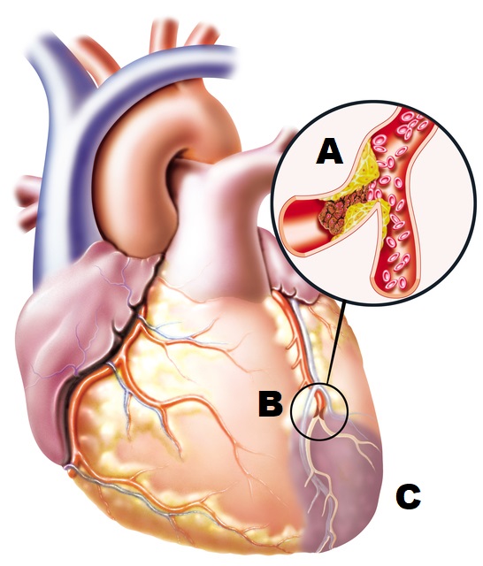 A) uma placa aterosclerótica no interior de um vaso sanguíneo, formando uma obstrução B) um bloqueio de um vaso sanguíneo por um coágulo sanguíneo C) uma parte do coração com marcas escuras que não está coagulada (morta) Foto: Thinkstock desenho anatómico do coração com um vaso sanguíneo obstruído