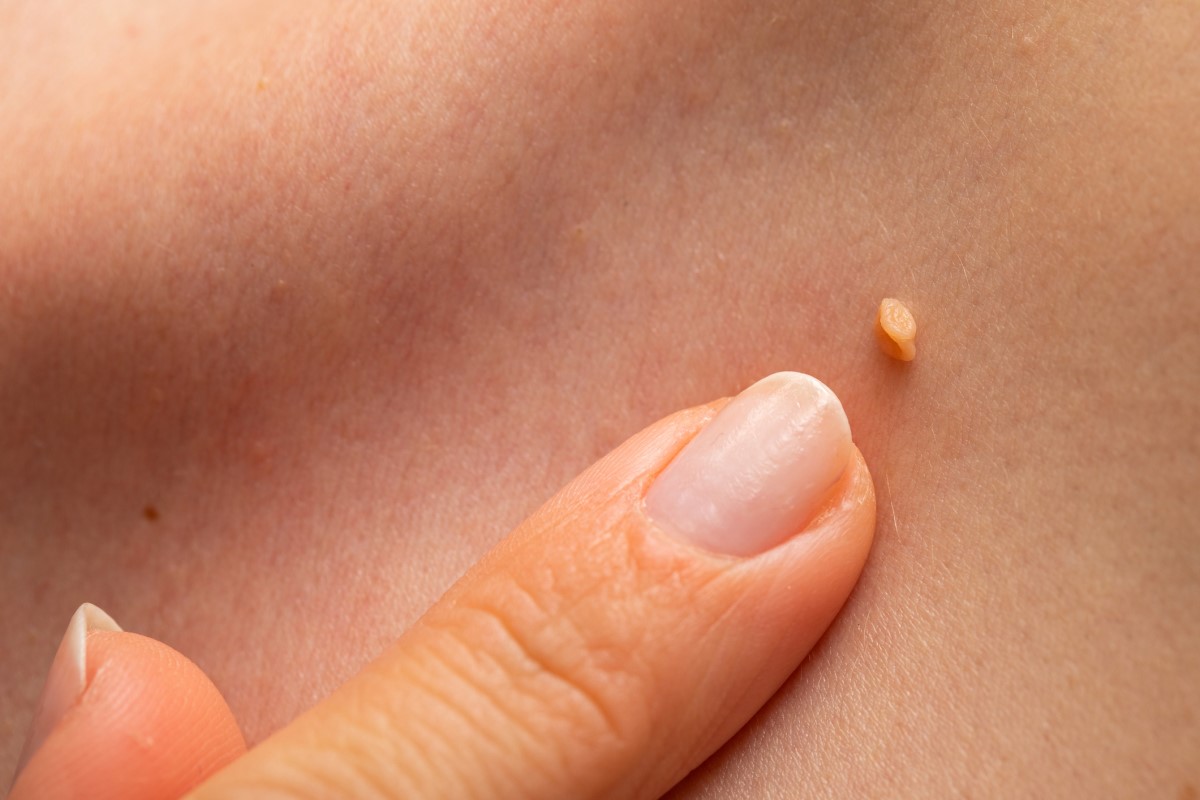 Verrugas de HPV na pele de uma mulher