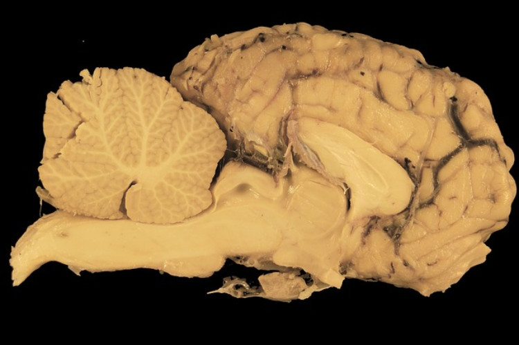 Uma secção transversal de tecido cerebral: Getty Images secção transversal de tecido cerebral