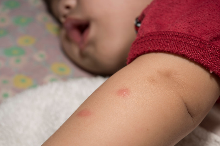 Picadas de mosquito Fonte: thinkstock photos um miúdo com uma T-shirt vermelha e uma picada de mosquito no braço