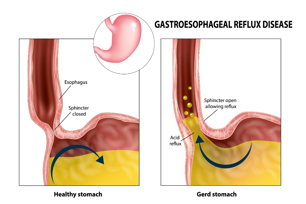 Refluxo gastroesofágico: esófago, esfíncter, estômago e ácido gástrico: Getty Images Refluxo gastroesofágico: esófago, esfíncter, estômago e ácido gástrico