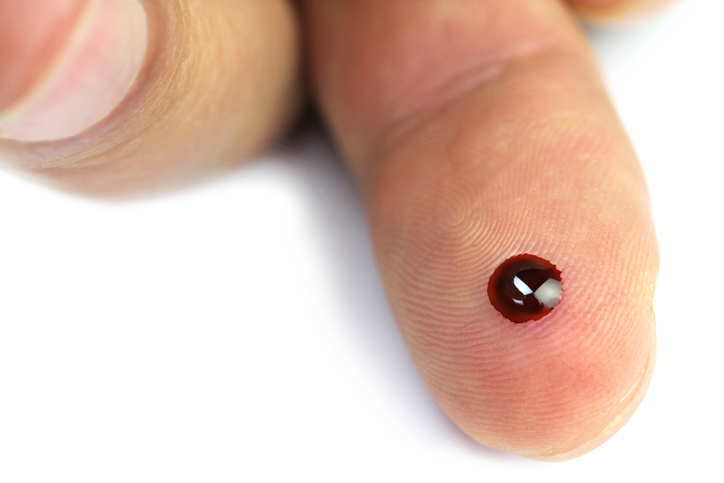 Uma pequena gota de sangue é suficiente para medir a glicémia em casa Fonte Getty Images Glicémia - uma gota de sangue na barriga do dedo após uma picada de agulha para medir o açúcar no sangue
