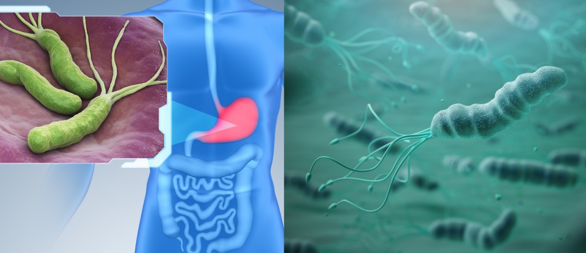 A Helicobacter pylori coloniza o revestimento do estômago e é um fator de risco para a gastrite, a úlcera e o cancro.