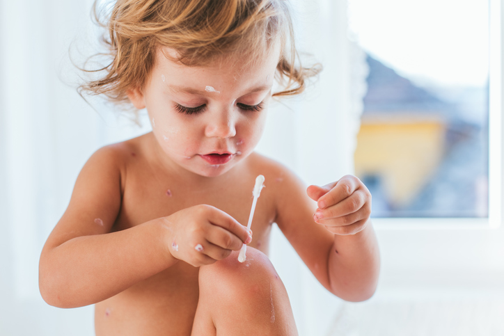 Também pode consultar a sua farmácia sobre cremes para a micose. Fonte: Thinkstock Uma criança nua trata da sua pele com um cotonete