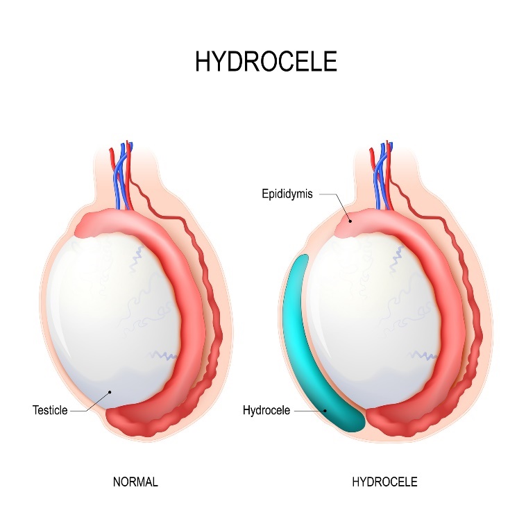 Hydrocele: Testicle (testículo), Epididymis (epidídimo), Hydrocele (líquido acumulado) Fonte: Getty Images Hidrocele: testículo, epidídimo, Hidrocele (líquido acumulado)