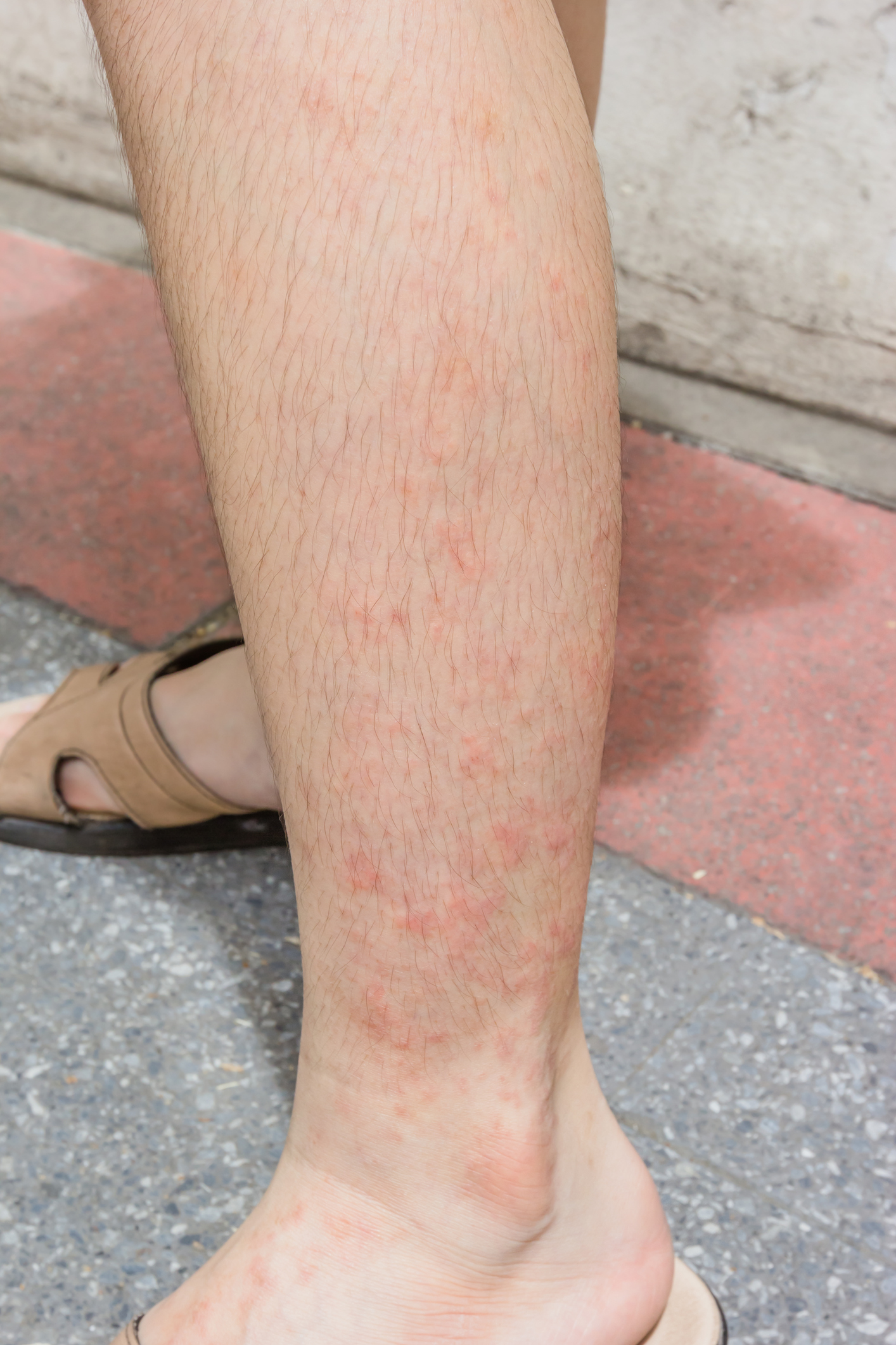 Vermelhidão Foto: Thinkstock vermelhidão da pele no eczema de contacto