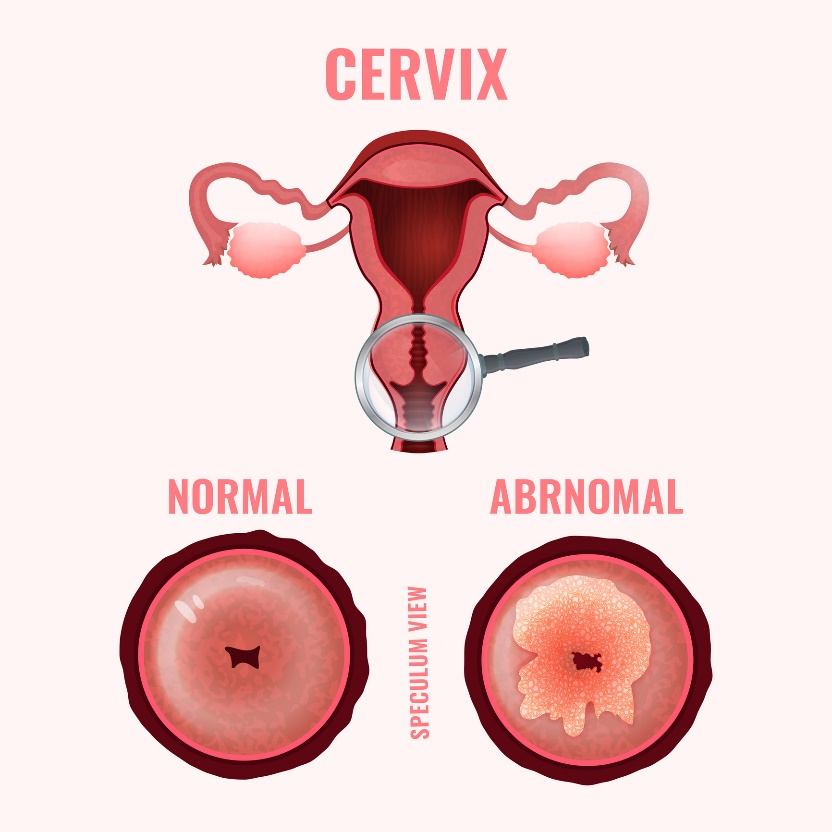 O colo do útero: estado fisiológico e alterações anormais do tecido cervical: Getty Images Cólicas uterinas