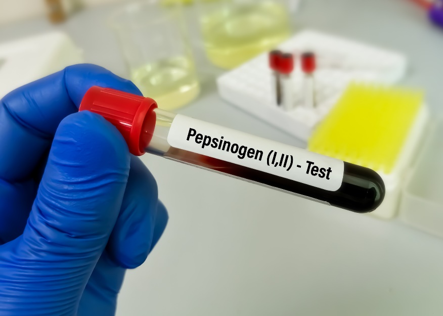 Amostra de sangue para análise laboratorial dos níveis de pepsinogénio e doenças gastrointestinais: Getty Images Amostra de sangue para análise laboratorial dos níveis de pepsinogénio e da doença gastrointestinal