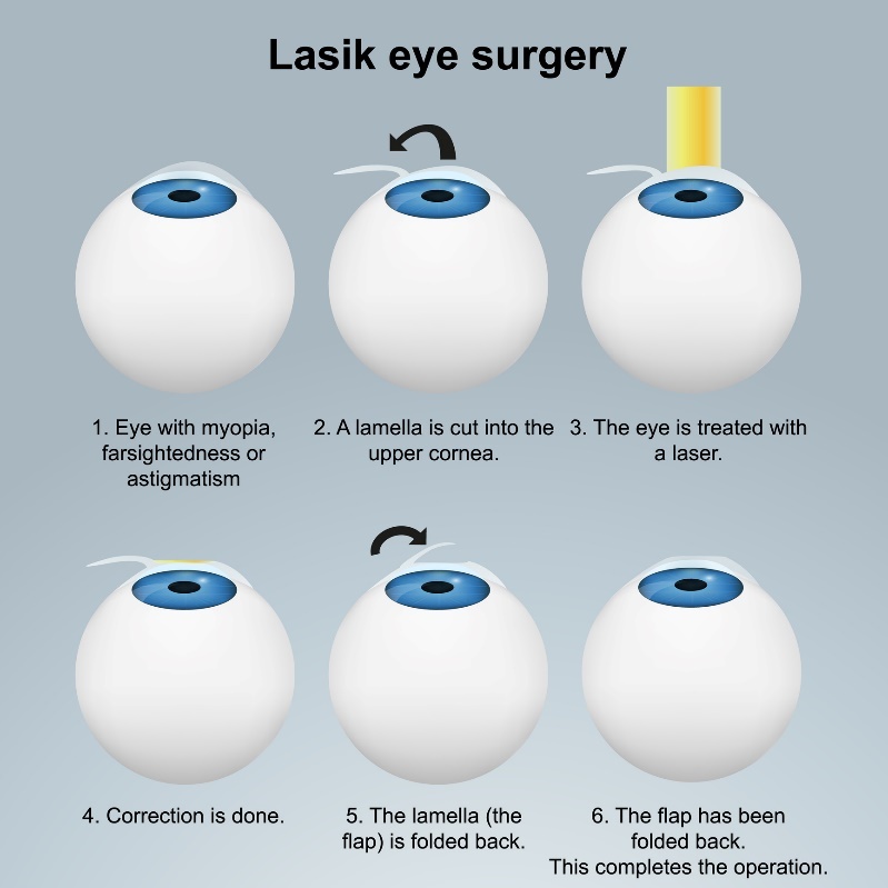 Cirurgia ocular a laser LASIK - um método subsuperficial. Um procedimento de retalho/flap sem danificar as terminações nervosas. Fonte: Getty Images Cirurgia ocular a laser LASIK - método subsuperficial. Procedimento com retalho/flap sem danificar as terminações nervosas.