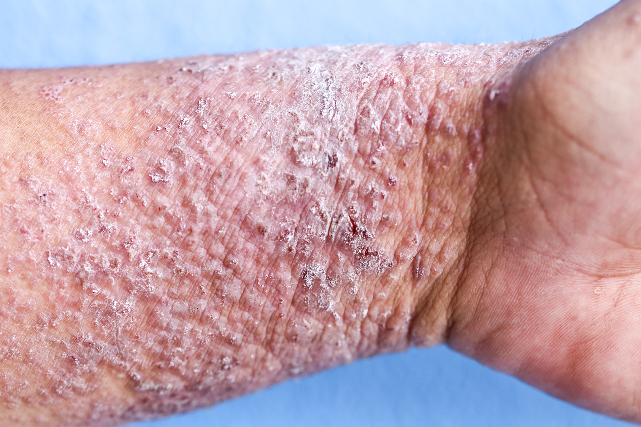 Liquenificação - espessamento da pele no eczema atópico Foto: Thinkstock liquenificação - espessamento da pele no eczema atópico