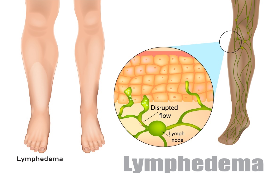 Linfedema (Linfedema, fluxo perturbado, gânglios linfáticos) Fonte da foto: Getty Images Linfedema