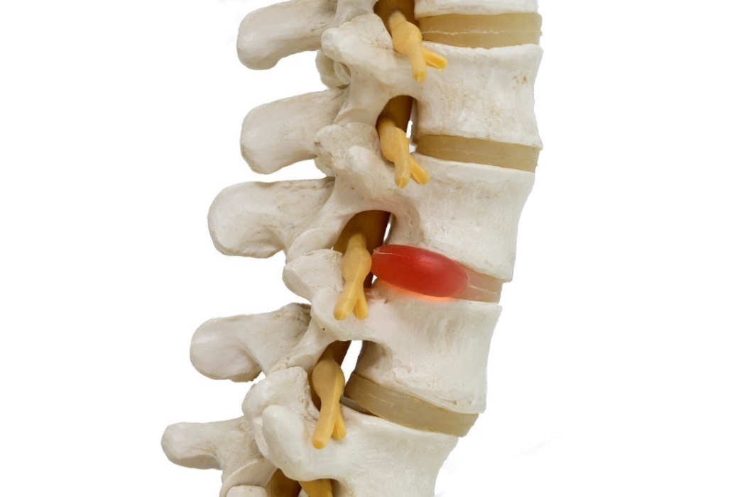 Uma possível causa de dor na coluna vertebral é a compressão do nervo por uma hérnia discal: Getty Images Representação anatómica de um modelo 3D da coluna vertebral, discos intervertebrais e hérnia discal com compressão nervosa