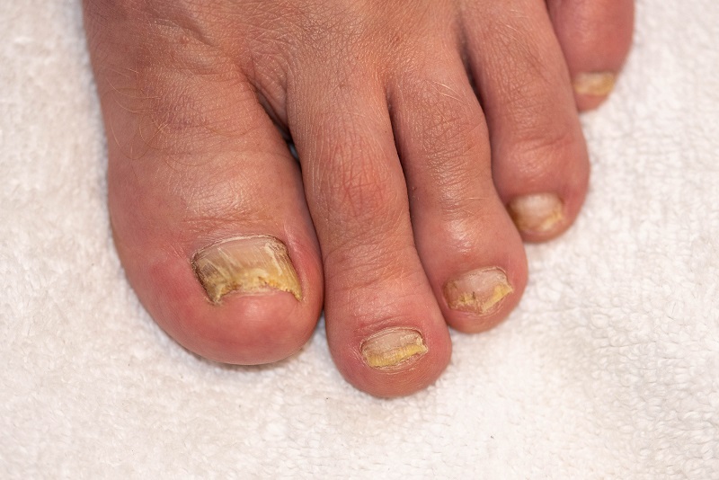 Infeção micótica das unhas dos pés. Fonte: Getty Images. Infeção micótica das unhas dos pés