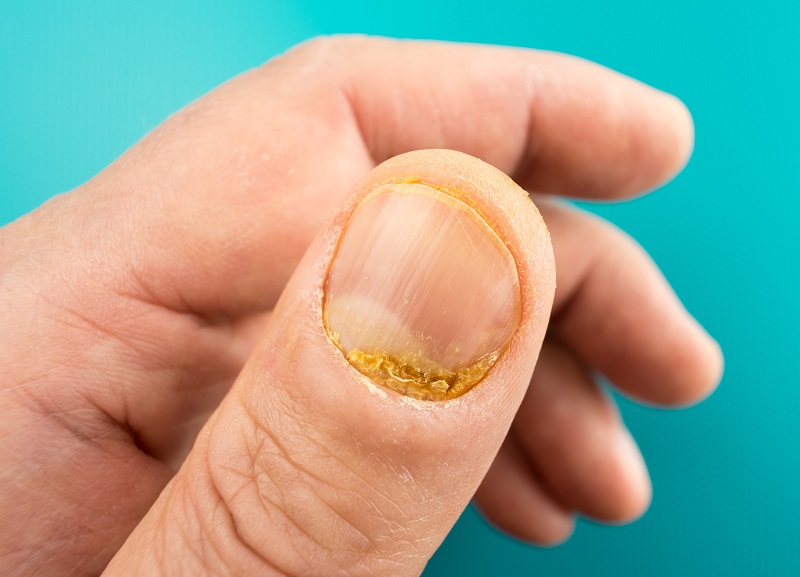 Uma unha com sintomas de psoríase. Fonte: Getty Images. Uma unha do polegar com sinais de psoríase.