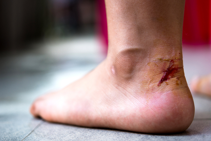 Uma ferida infetada com clostridium causa tétano. Foto: Thinkstock pé lesionado na zona do calcanhar