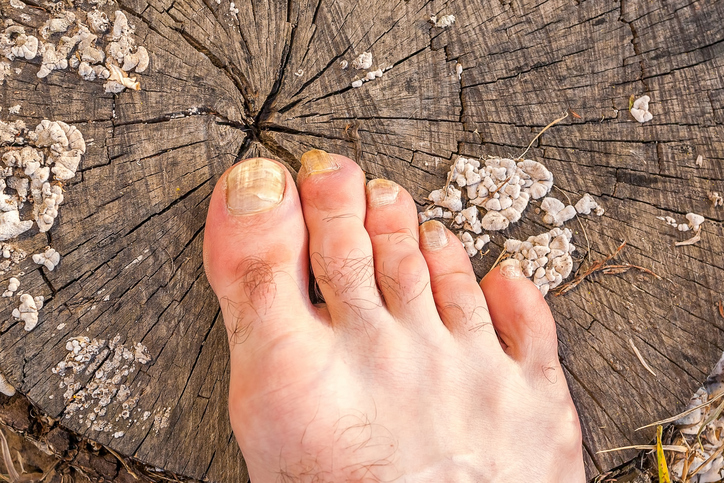 A micose das unhas é uma doença desagradável e inestética que provoca deformações nas unhas. Fonte: Thinkstock um pé com fungos nas unhas, deitado num cepo de árvore