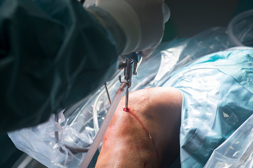 Cirurgia do joelho num paciente com gonartrose: Getty Images cirurgia artroscópica do joelho
