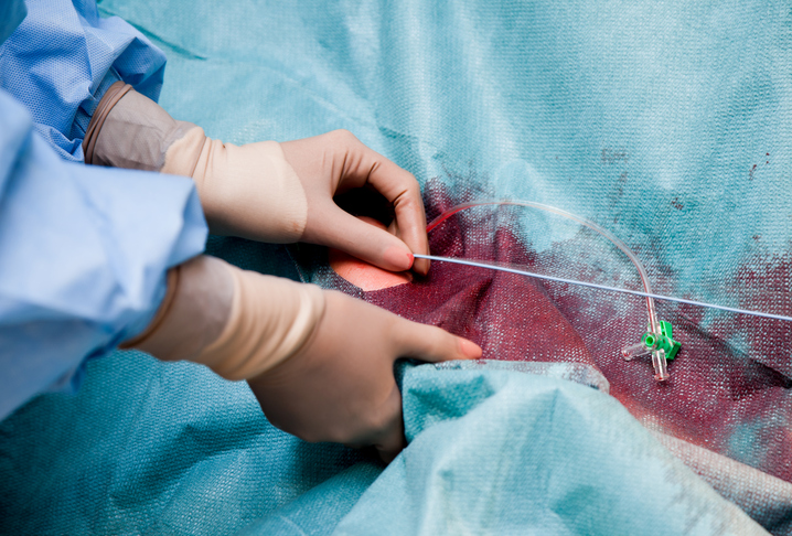 Num ataque cardíaco, é efectuada uma trombólise (dissolução do coágulo sanguíneo) ou um cateterismo - a inserção de um tubo (na foto). Foto: Thinkstock cirurgia cardíaca, cateterismo após ataque cardíaco, médico na sala de operações