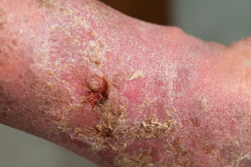 Fase inicial da gangrena do membro inferior. Fonte: Getty Images. A fase inicial da gangrena da perna