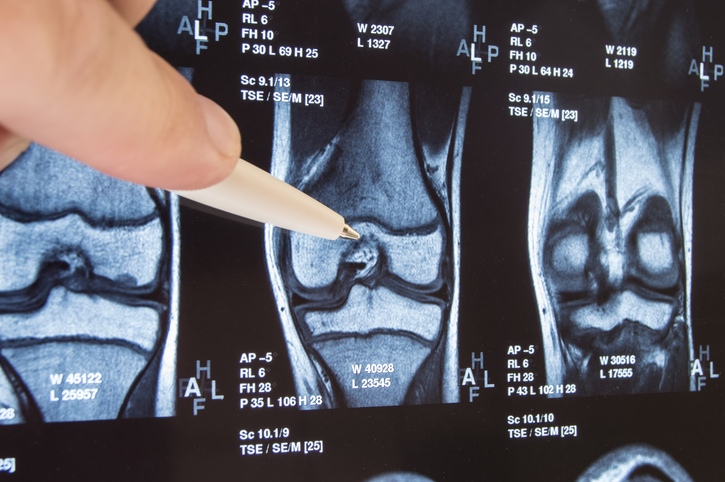 As alterações artróticas são visíveis na radiografia: Getty Images Radiografia com articulação