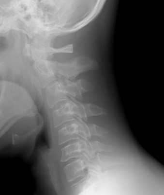 Radiografia da coluna cervical, foto de origem: Getty Images Radiografia da coluna cervical