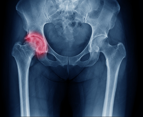 Artrose da articulação direita: Getty Images Radiografia da bacia, articulação da anca direita afetada por artrose